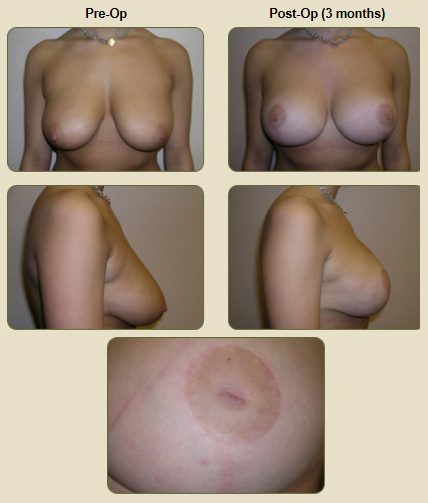 breast_lift_before_and_after_04