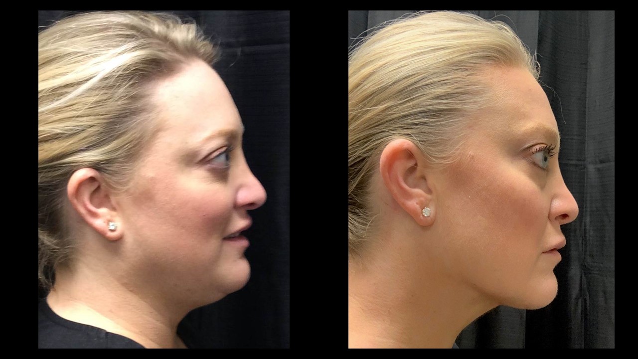 Lipo Neck before and after